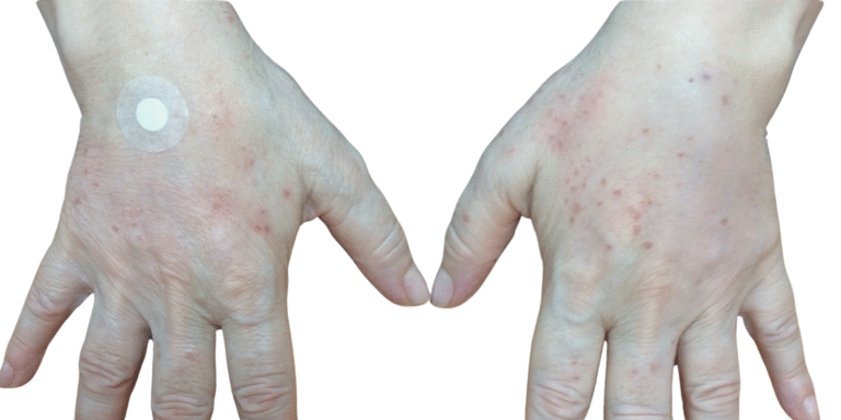 Bioestimuladores harmonizacao coporal (2)