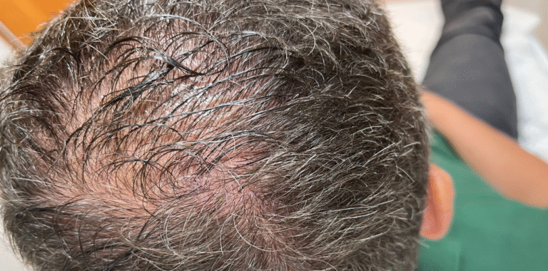 Tratamento para queda de cabelo (1) (1)