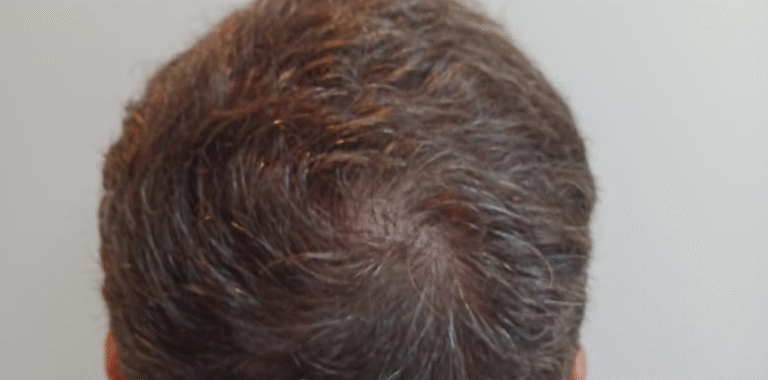Tratamento para queda de cabelo (1) (2)