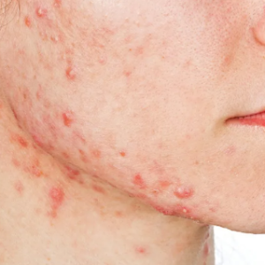 Você quer combater a acne? Veja isto!